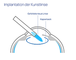 augen op kataraktchirurgie linse einsetzen 01