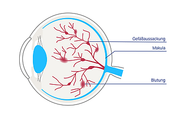 augenkrankheiten netzhauterkrankungen diabetische retinopathie nichtproliferativ 01