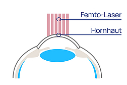 augen op sehen ohne brille femto lasik femtosekundenlaser 01