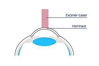 augen op sehen ohne brille photorefraktive keratektomie excimer laser 01