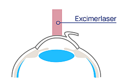 augen op sehen ohne brille femto lasik excimer laser 01