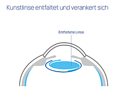 augen op kataraktchirurgie linse implantiert 01