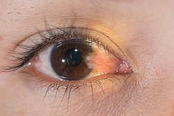 pterygium fluegelfell